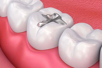 The image shows a close-up view of a human dental implant integrated into a tooth with a pink gum background, suggesting a focus on dental health and implants.