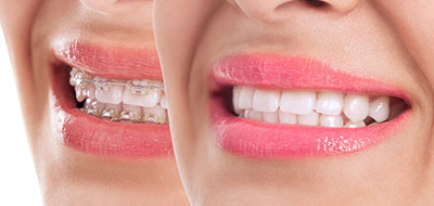 The image shows a woman s face with a smile, featuring pink lipstick and teeth, presented from two different angles side by side.