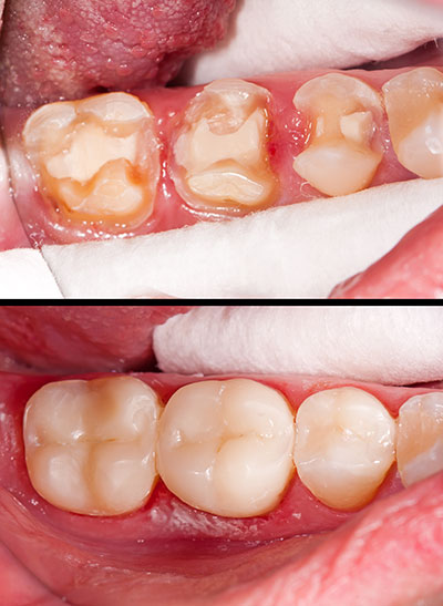The image displays a close-up view of a person s mouth with teeth showing signs of decay and gum disease, emphasizing oral health concerns.