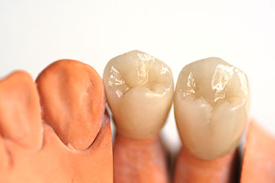 The image displays three dental implants with artificial gums, showcasing their color and texture, likely for educational or promotional purposes related to dental care or implant services.