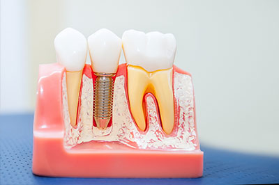 The image shows a model of a human mouth with teeth, gums, and a dental implant, displayed against a blue background.