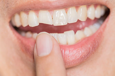 An up-close view of a person s smiling mouth with teeth, revealing a partial tooth replacement, taken from a low angle.