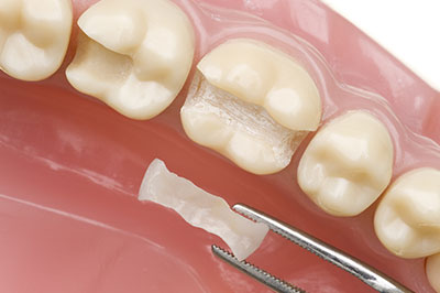 The image shows a close-up view of a dental implant being placed into a tooth socket with a surgical instrument visible next to the implant.