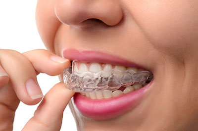 The image shows a person with a smile, holding a toothbrush, with their teeth aligned and wearing clear braces.