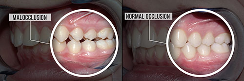 The image shows two photographs side by side of a person s mouth with teeth before and after dental treatment, highlighting the difference between natural teeth and those affected by malocclusion.
