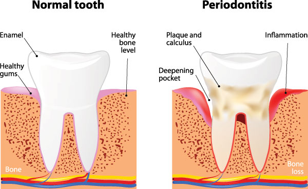 The image is a medical illustration showing three stages of tooth decay progression from normal to severe, with labels explaining each stage and annotations indicating the affected areas.