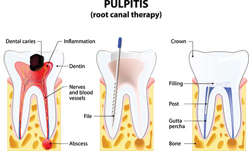 The image depicts a medical illustration showing the structure of a human tooth with labels indicating different parts such as enamel, dentin, pulp cavity, root canal therapy, dental caries, inflammation, crown, filling, and tooth abscess.
