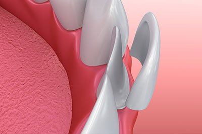 The image shows a close-up view of a dental implant with a visible screw protruding from the gum, set against a pink background which appears to be the interior of a mouth.