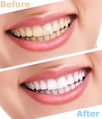 The image displays a before-and-after comparison of teeth whitening, featuring two photos of a person s smile with text indicating the transformation achieved through cosmetic dental treatment.
