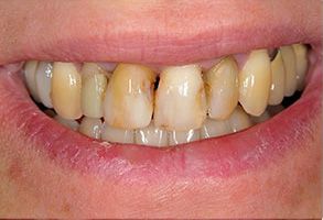 An individual s teeth with yellowing and staining, suggesting poor oral hygiene.
